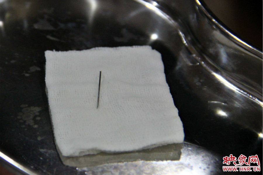 上午11點30分許，小龍腦中鋼針已經成功取出。