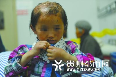 被燙傷的頭皮一直沒有愈合。