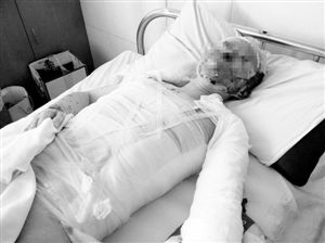 周小姐的頭、頸、軀干、四肢均被燒傷，其中面部燒傷最為嚴(yán)重。