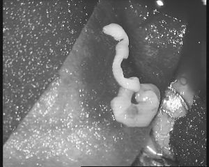 取出的蟲(chóng)子在顯微鏡下顯得有些瘆人 取出的蟲(chóng)子在顯微鏡下顯得有些瘆人