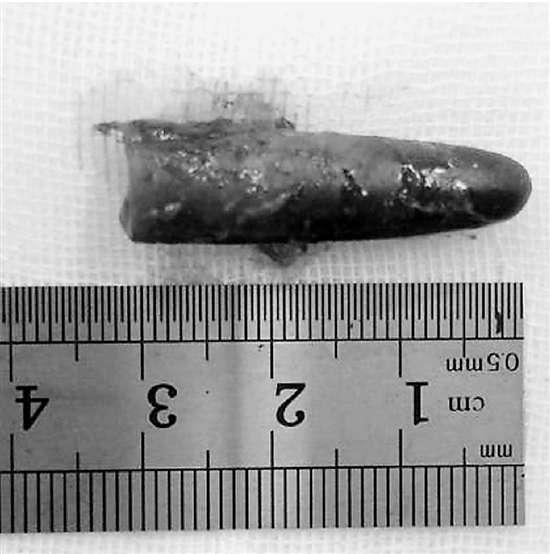 小伙做作業(yè)愛(ài)咬筆頭 筆帽堵塞氣管致左肺不見(jiàn)