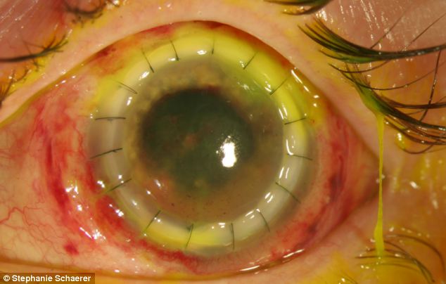 恐怖慎入！隱形眼鏡致英女子摘除眼球