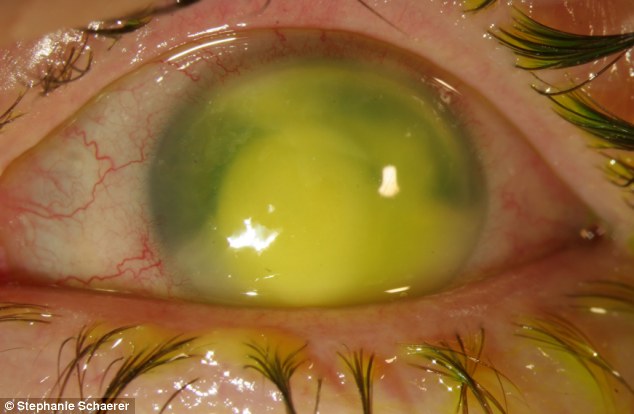 恐怖慎入！隱形眼鏡致英女子摘除眼球