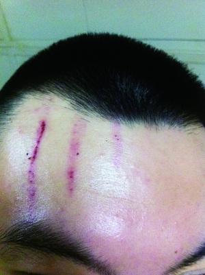 　2013年，被打者受傷照