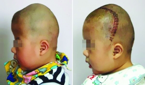 術(shù)前（左），術(shù)后（右）