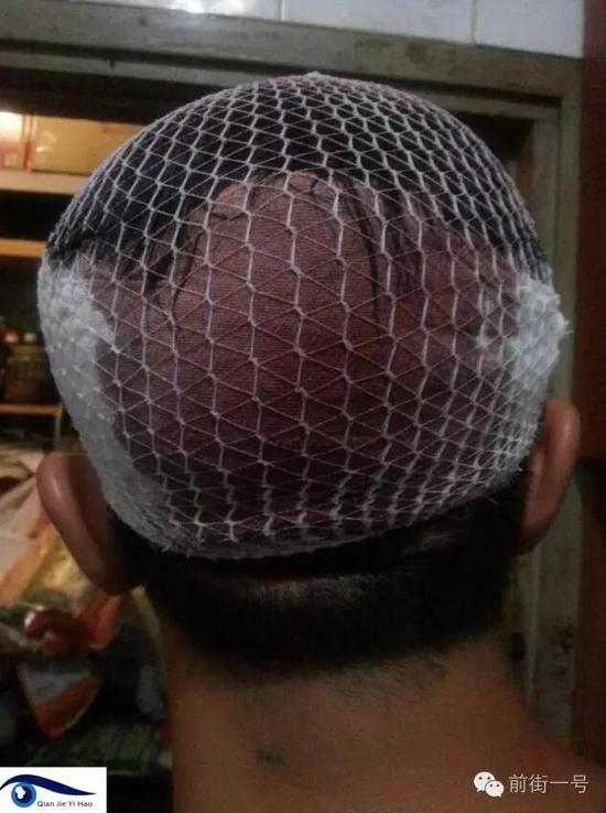 李律師受傷后縫合三針。