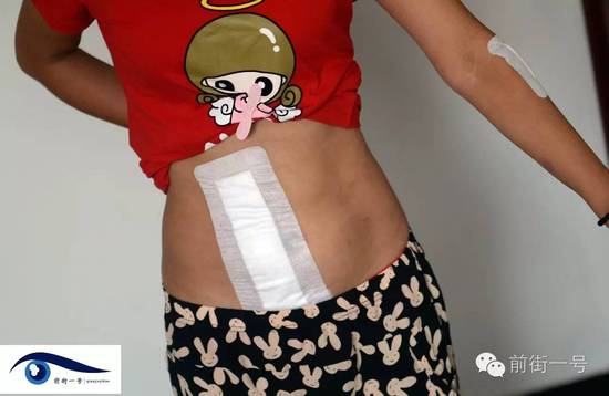 小金腹部的傷口。