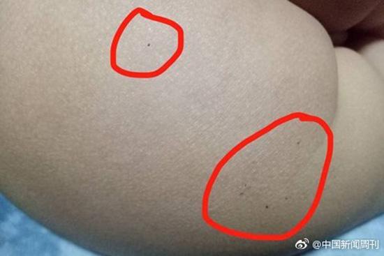 據(jù)多名紅黃藍(lán)(新天地分園)家長(zhǎng)反映，孩子腿部、屁股、腋下出現(xiàn)針眼。