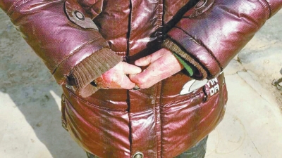 長期受損的手指，已經(jīng)長在了一起。