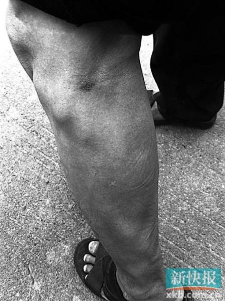 傷者身上遺留的彈痕。