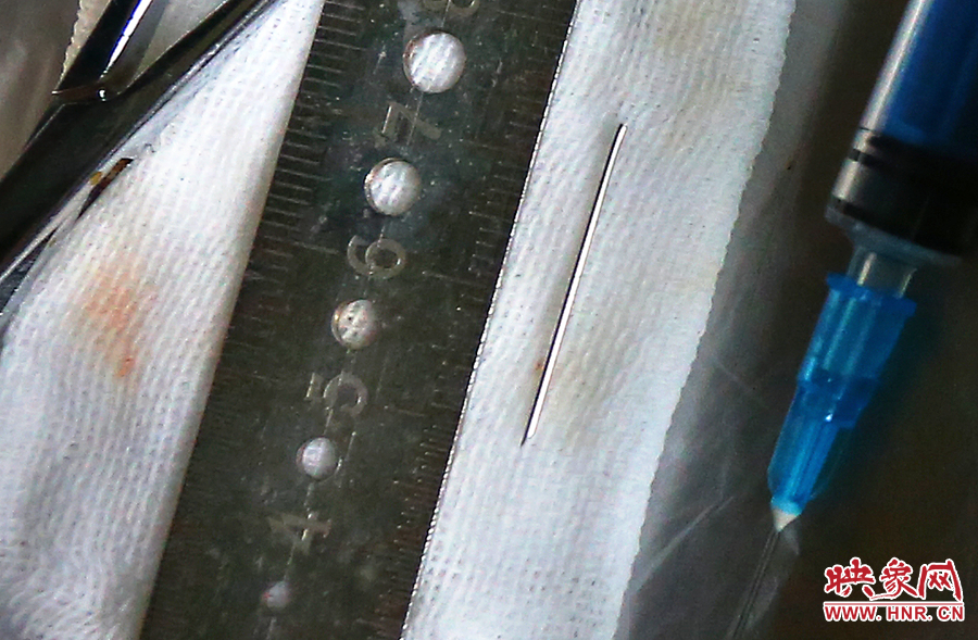 上午11點42分，大龍顱內(nèi)的鋼針被取出