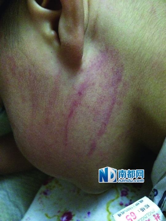 小逸臉上淤痕清晰可見(jiàn)。