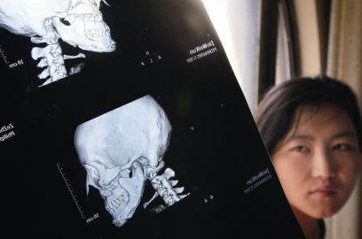 國內(nèi)醫(yī)院CT顯示，如今靳魏坤的鼻子假體是歪的，連下巴也是歪的