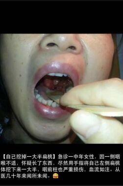 圖片來(lái)自市三醫(yī)院耳鼻喉科醫(yī)生朋友圈