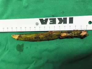 插入男子腦內(nèi)的樹枝。