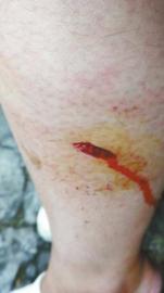 郭女士腿上被猴子咬的傷口。(受訪者供圖)