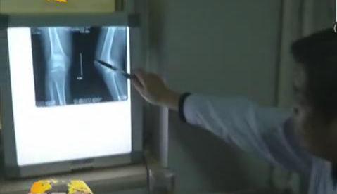 冷空氣來(lái)襲 如何預(yù)防老寒腿？