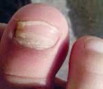 一幼兒園兒童“指甲異?！? title=